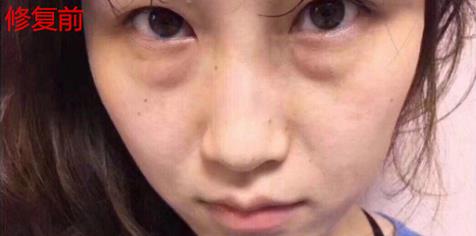 幻柔筆記：眼袋修復后氣質立現，怎么看都是青春靚麗！