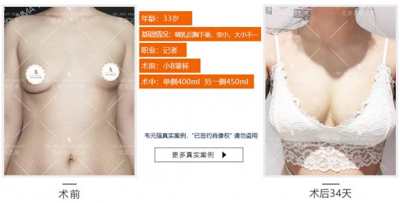韋元強：產(chǎn)后能做自體脂肪豐胸嗎？