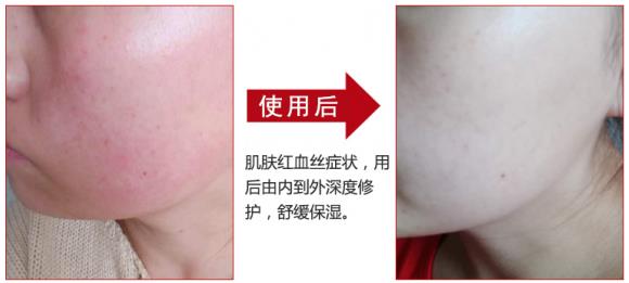 放心！有美薏升修復敏感肌紅血絲專家產品在，你每天都可以美美噠