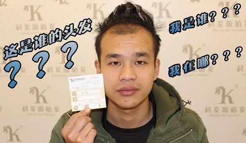 青島大麥微針植發2500毛囊單位，術后8個月恢復頭發濃密