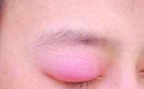 眼皮腫是怎么回事，眼皮腫是怎么快速消除